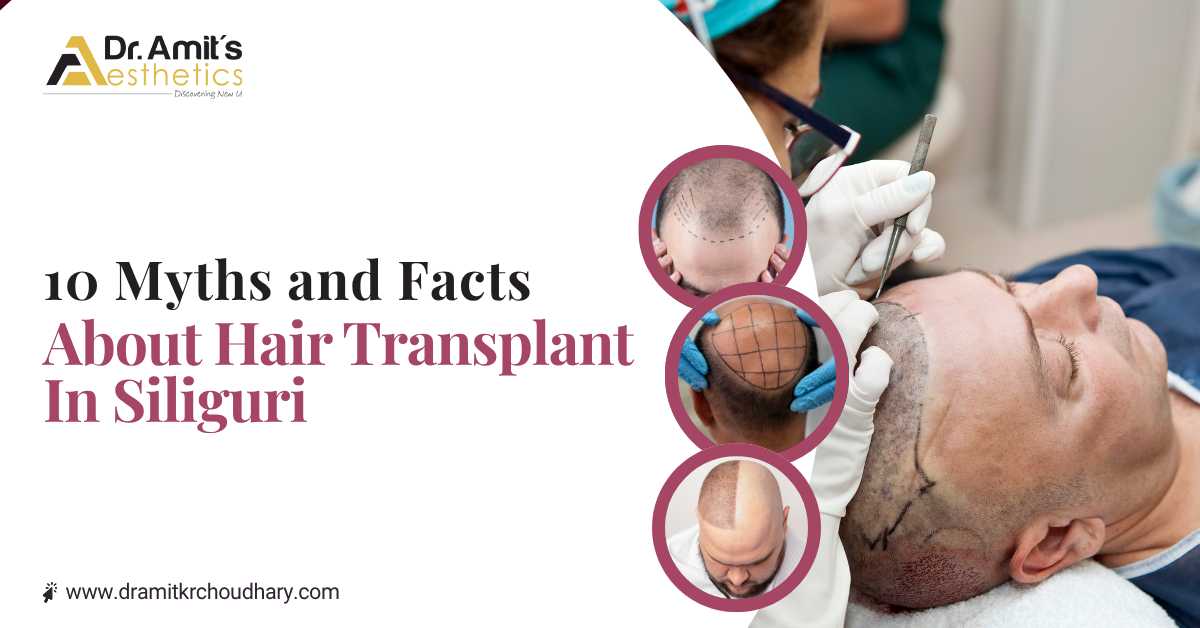 10 Myths and Facts About Hair Transplant in Siliguri