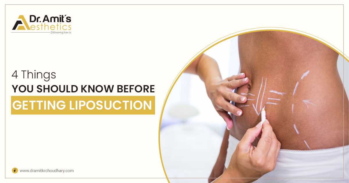 4 Things You Should Know Before Getting Liposuction