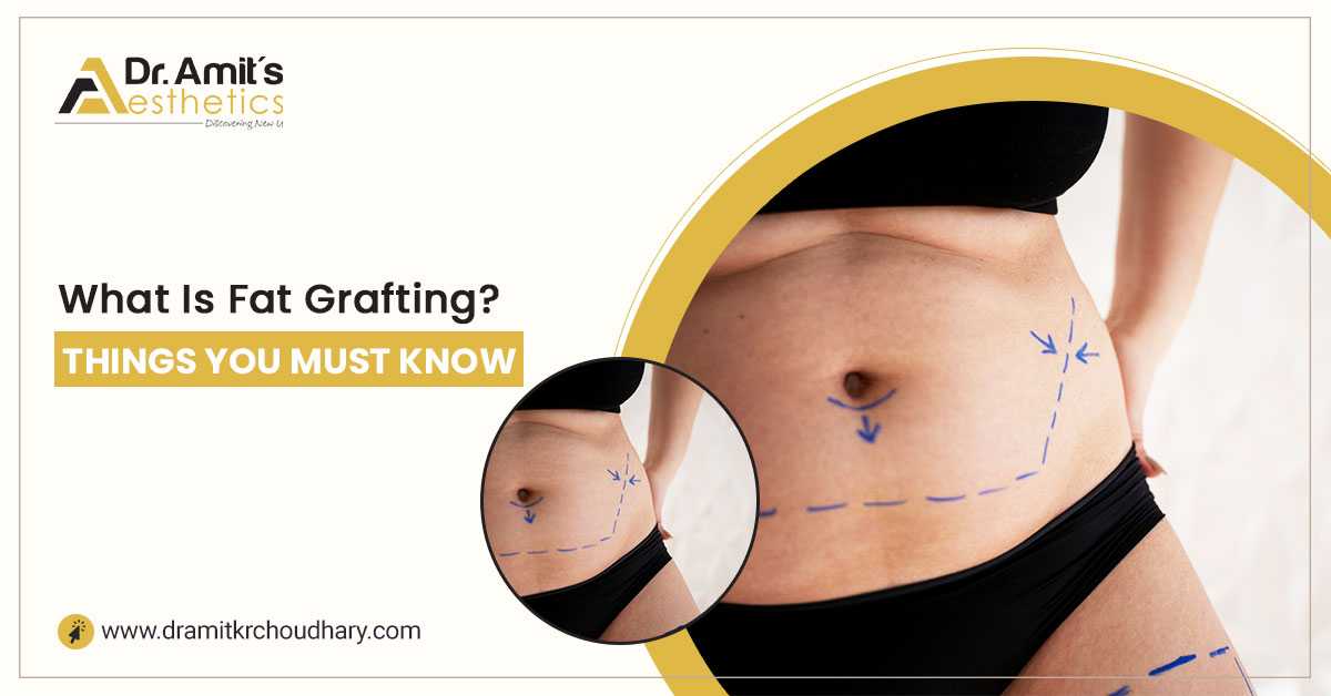 What Is Fat Grafting? - Things You Must Know
