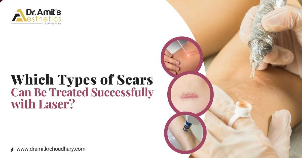 Which types of scars can be treated successfully with laser?