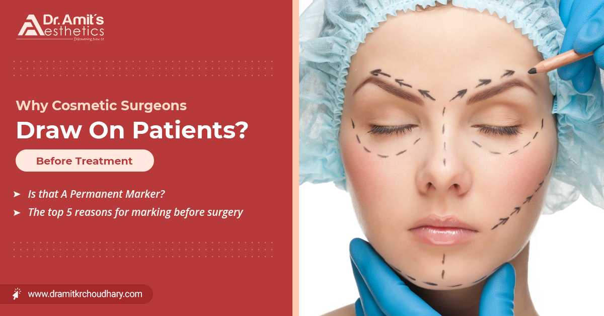 Why Cosmetic Surgeons Draw on Patients Before Surgery