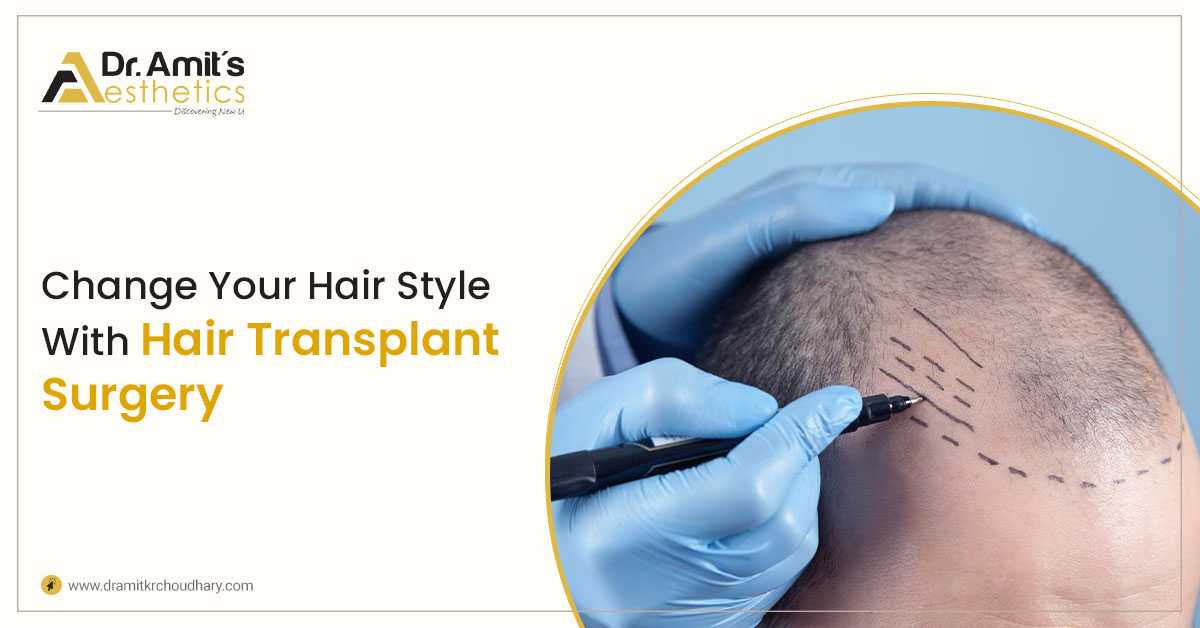 Change Your Hair Style With Hair Transplant Surgery