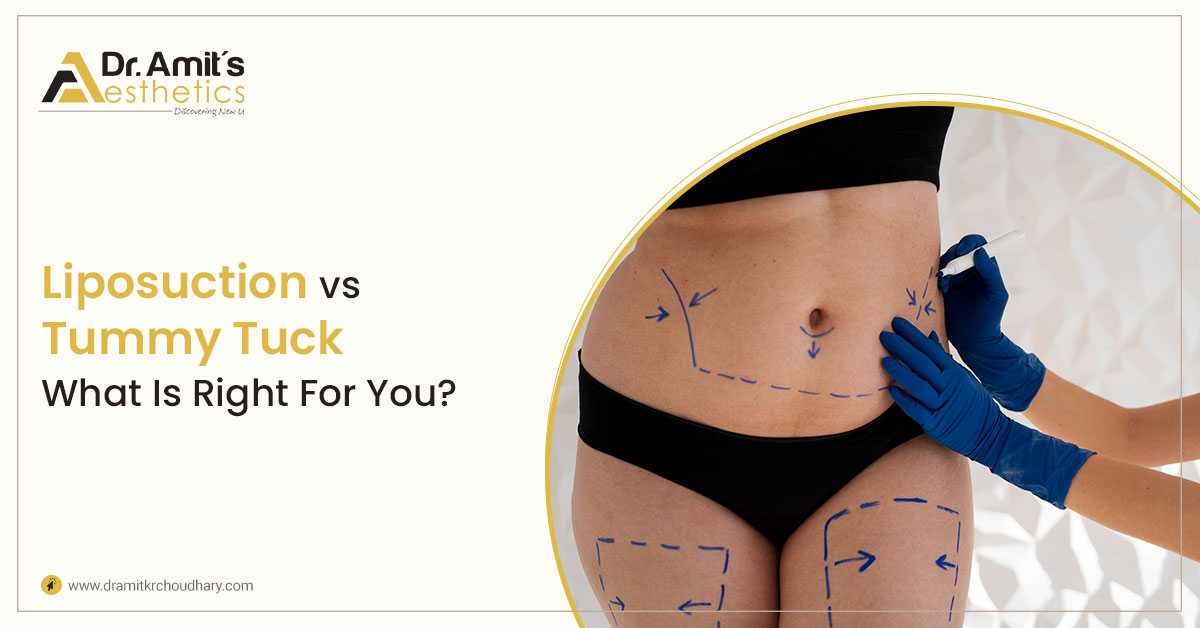 Liposuction Vs Tummy Tuck – What Is Right For You?