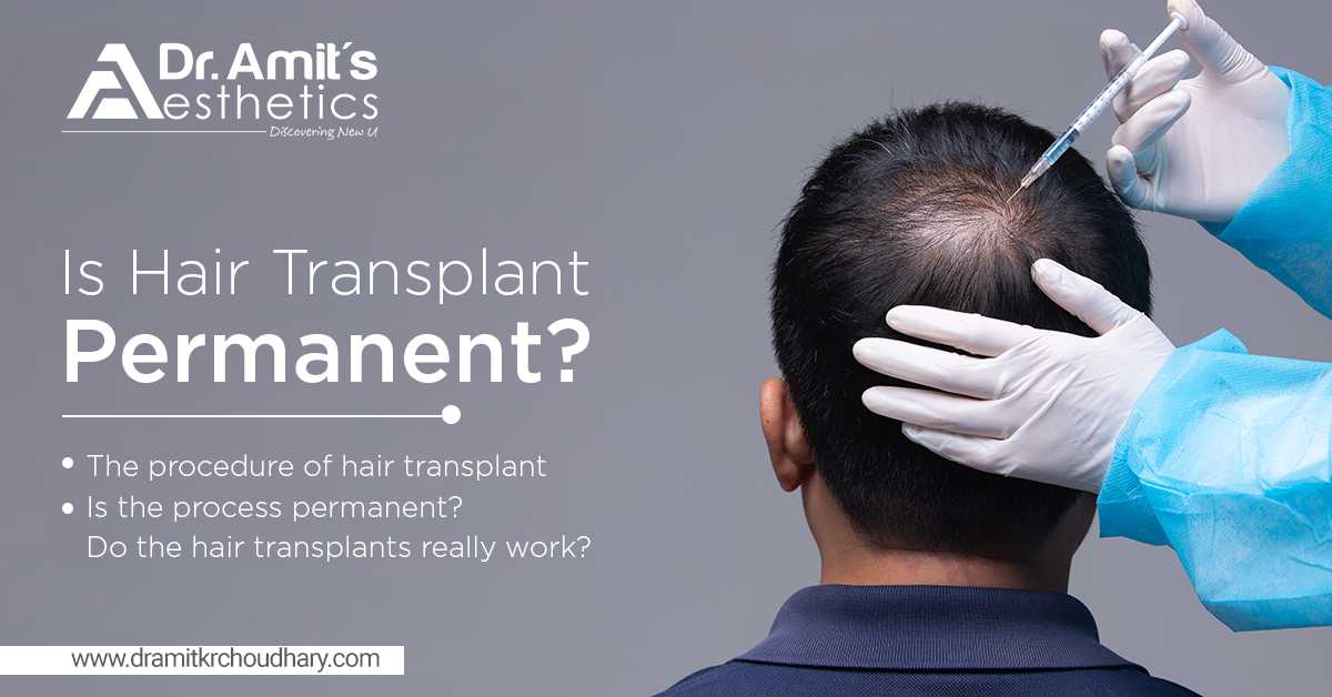 Is Hair Transplant Permanent?