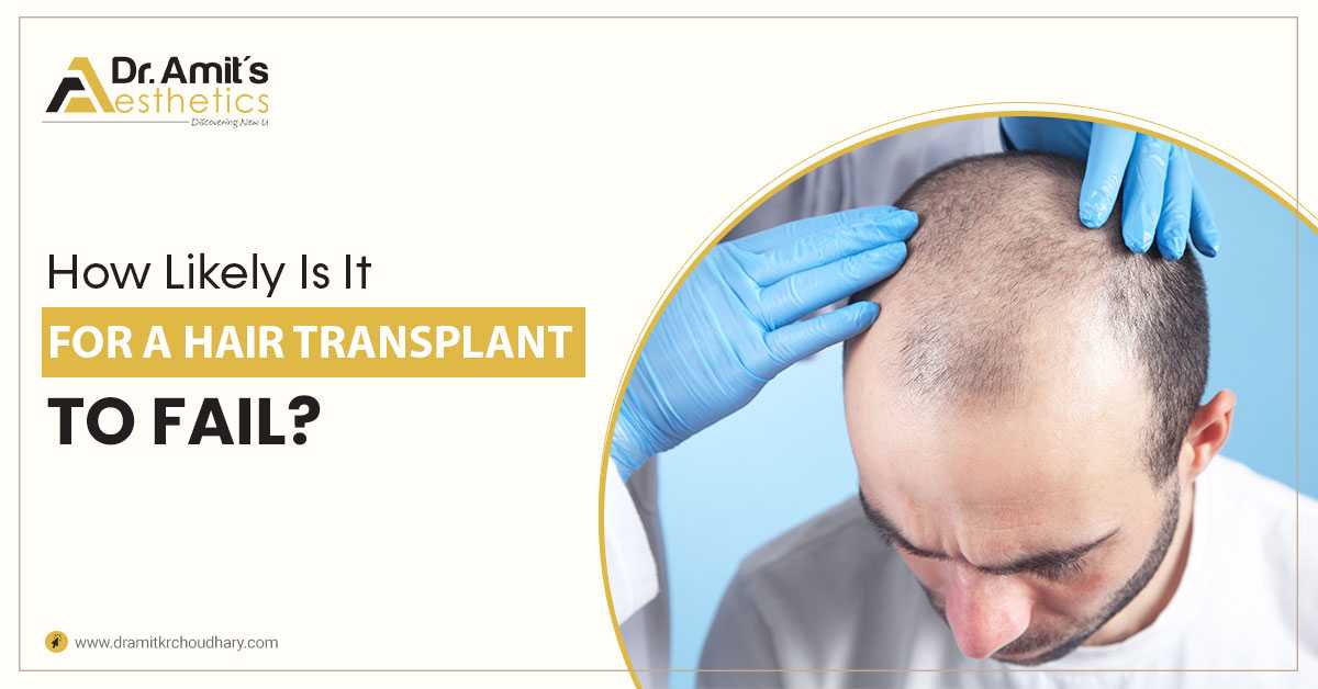 How Likely Is It for a Hair Transplant To Fail?