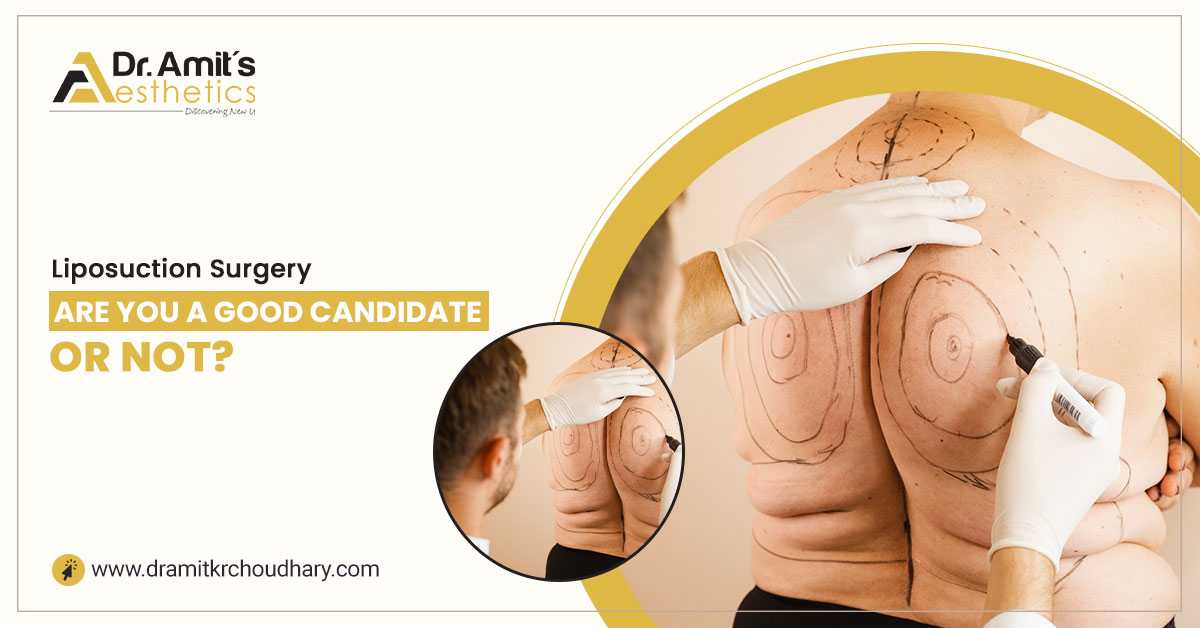 Liposuction Surgery – Are You a Good Candidate or Not