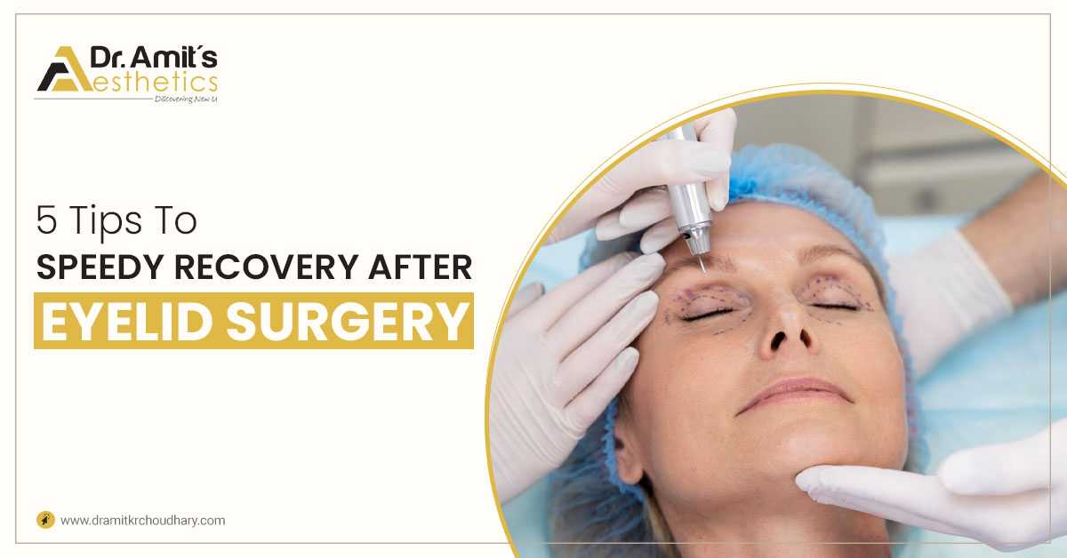 5 Tips To Speed Recovery After Eyelid Surgery