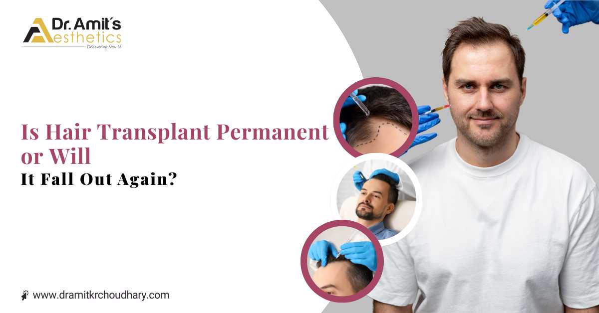 Is Hair Transplant Permanent or Will It Fall Out Again?