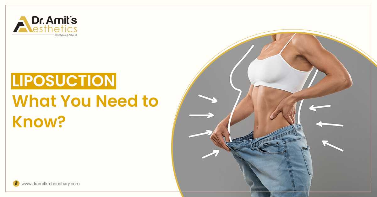 Liposuction - What You Need to Know?