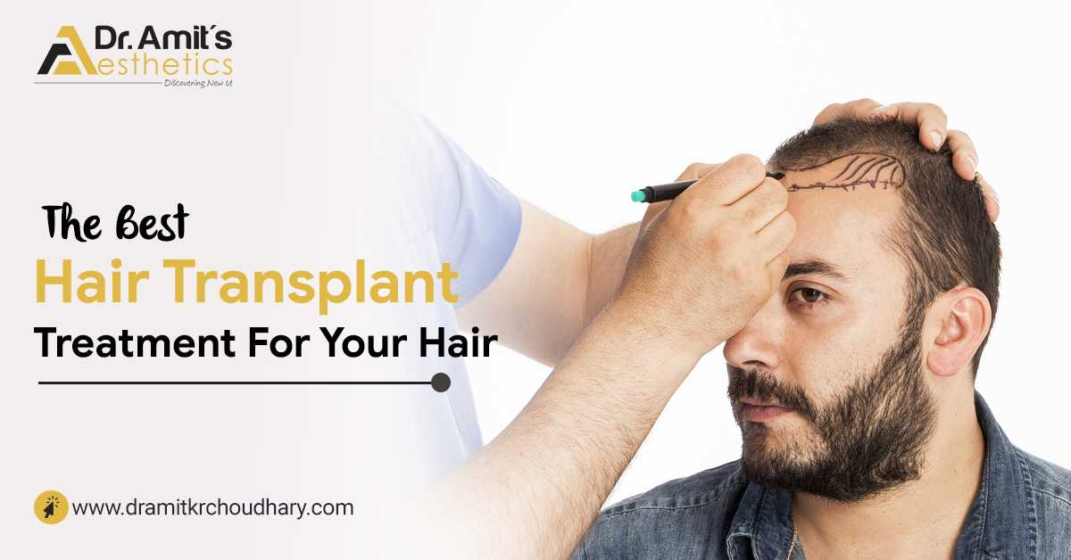 Hair Transplant – The New Way To Improve Your Hair