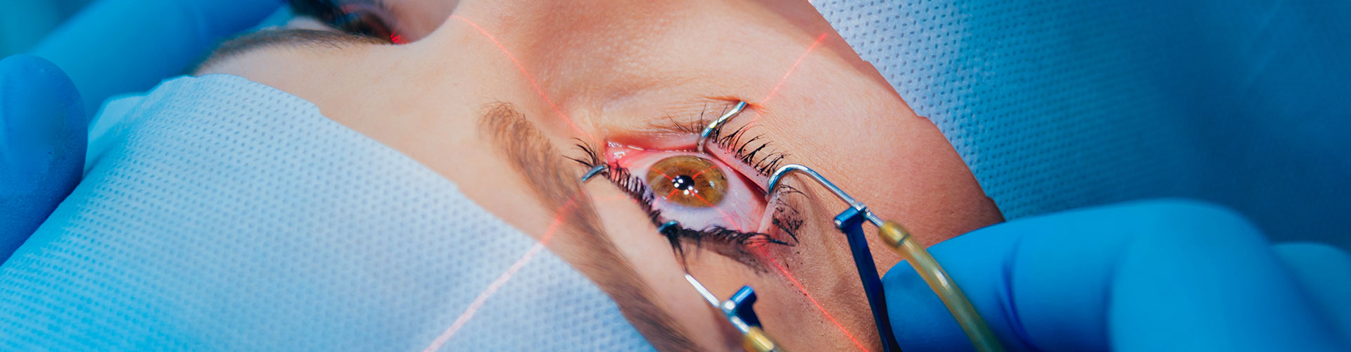 Eyelid Surgery in Siliguri