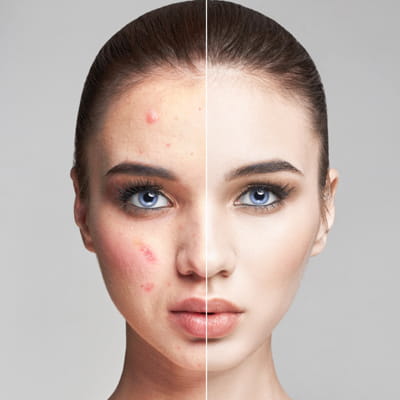 Acne & Acne Scar