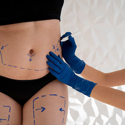 Liposuction