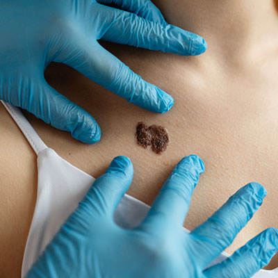 Mole Excision