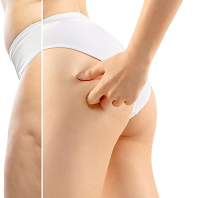 Thigh Lift